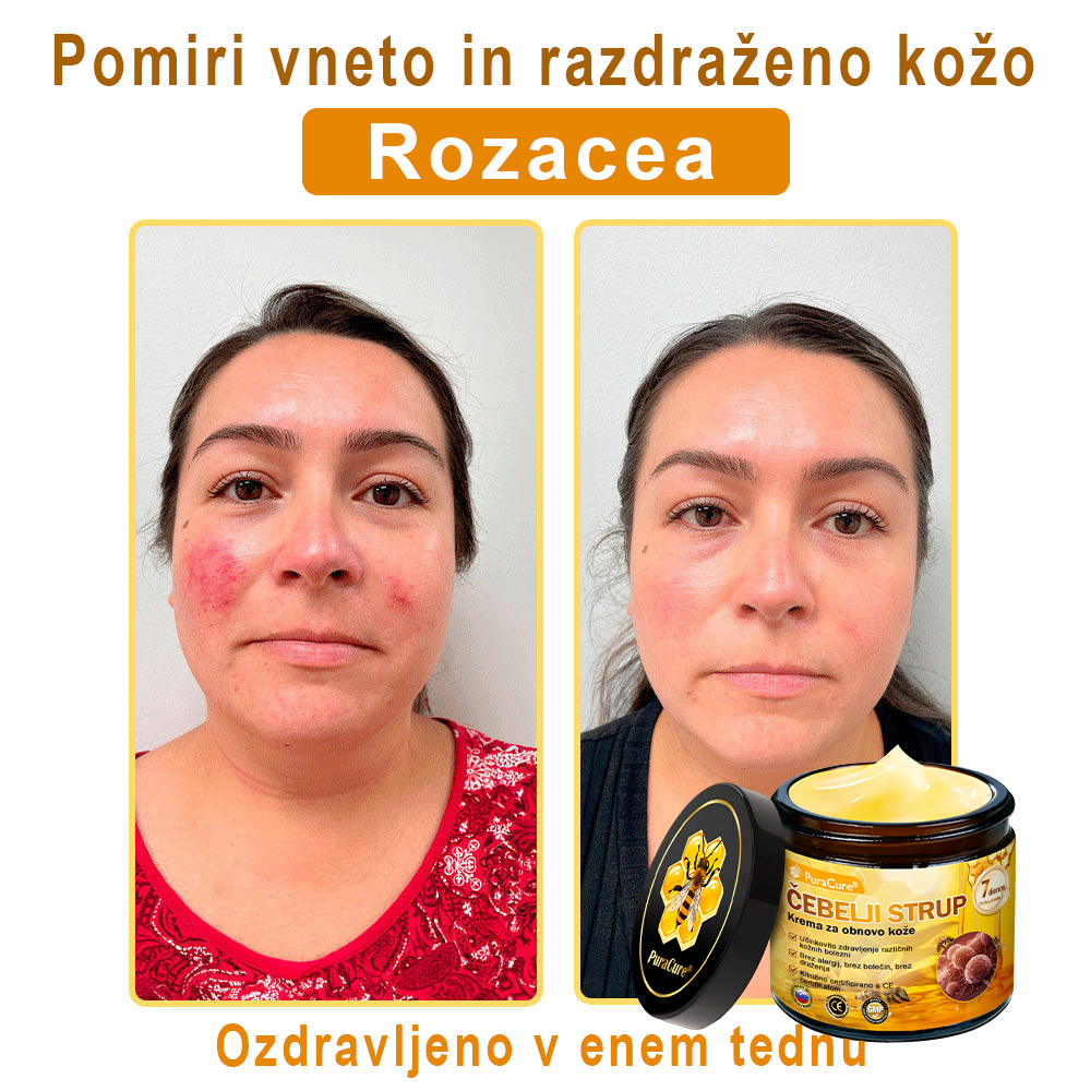 🔥 PuraCure® Krema za obnovo kože z čebeljim strupom | 50 ml | Priporočeno češko dermatovenerološko društvo