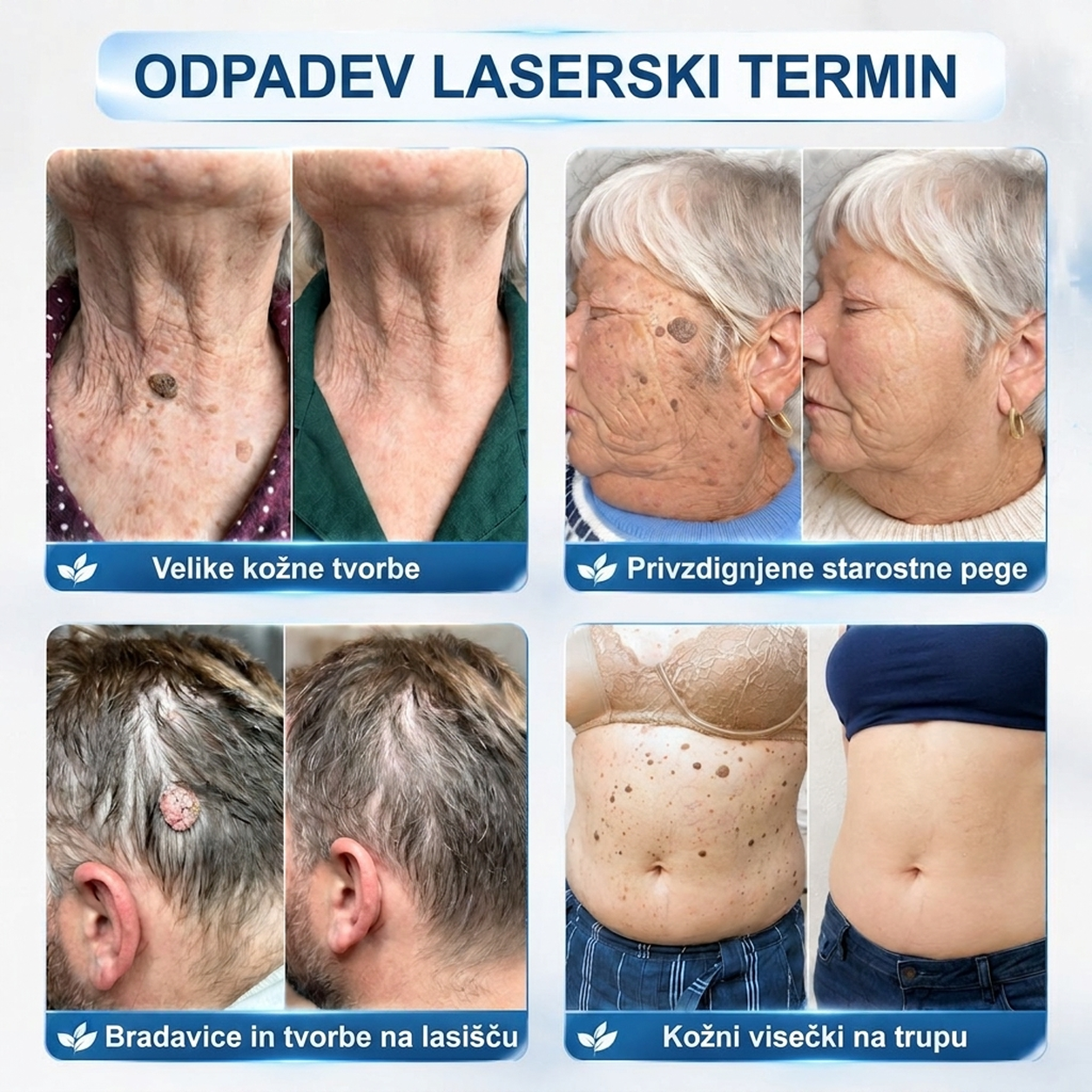 ✨ PuraCure® Rezultati so vidni že v 7 dneh! Valjček za odstranjevanje bradavic in drugih kožnih težav | Neboleče in minimalno razmaže.