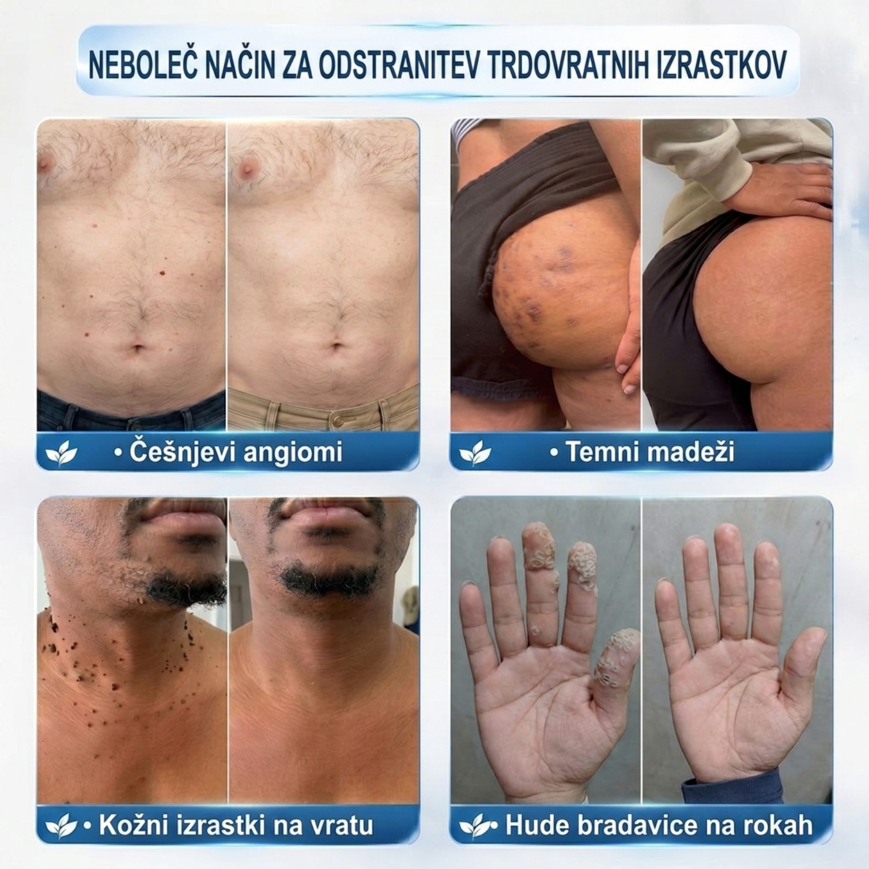 ✨ PuraCure® Rezultati so vidni že v 7 dneh! Valjček za odstranjevanje bradavic in drugih kožnih težav | Neboleče in minimalno razmaže.