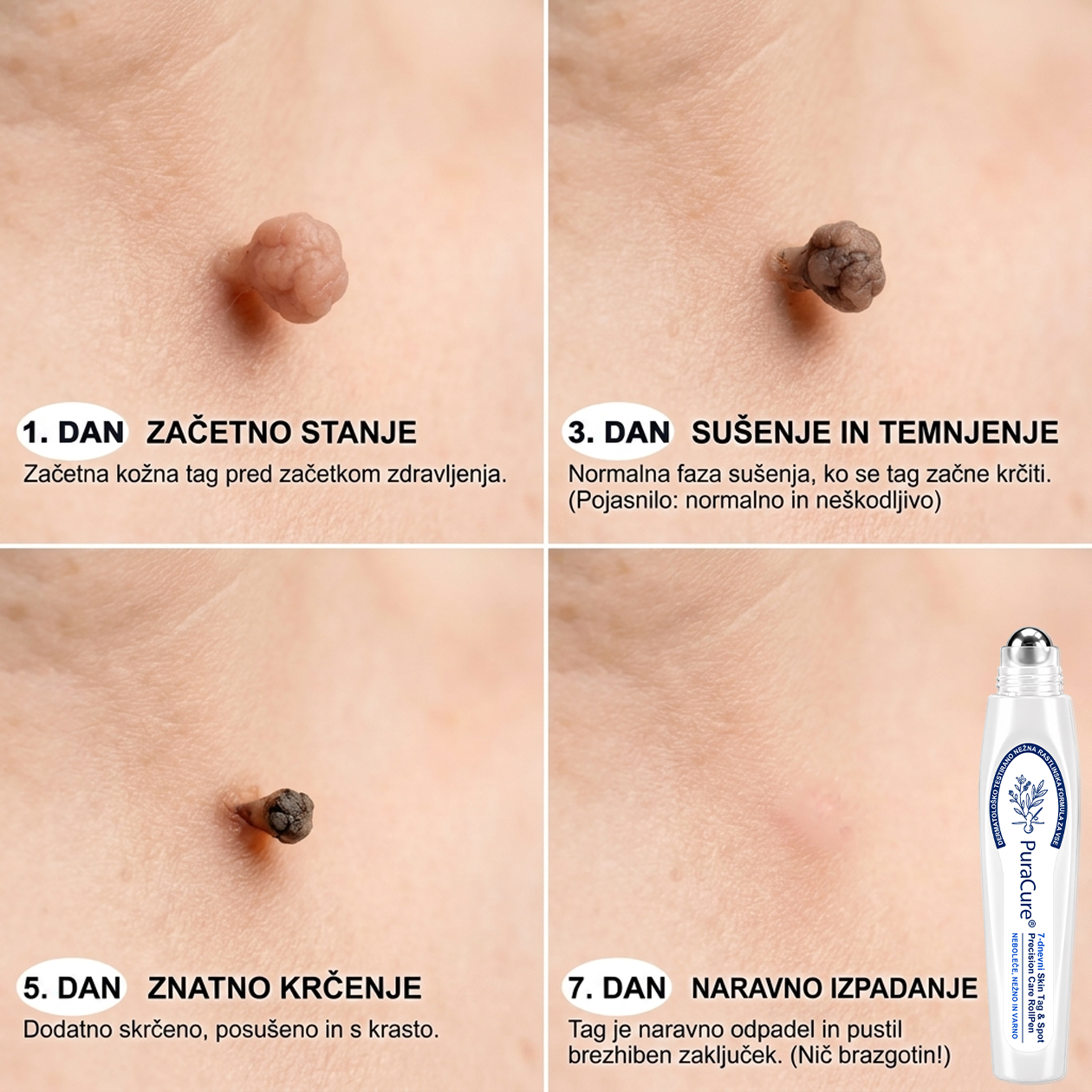 ✨ PuraCure® Rezultati so vidni že v 7 dneh! Valjček za odstranjevanje bradavic in drugih kožnih težav | Neboleče in minimalno razmaže.